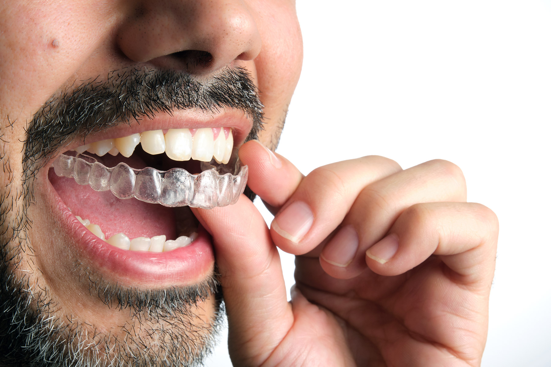 Aligner-Behandlung