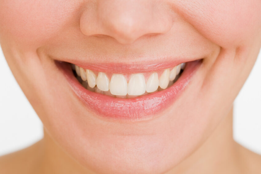 Vunder Orthodontics Erwachsene Festsitzende Zahnspange innen