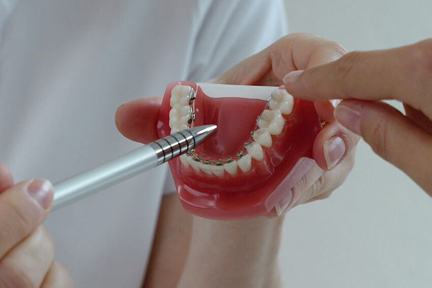 Vunder Orthodontics Zahnspange innen